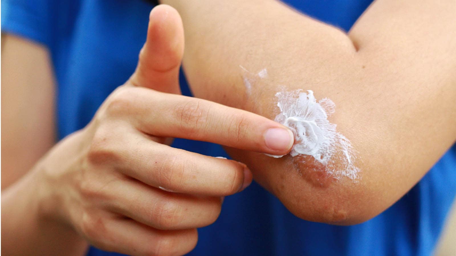 5 best antiseptic creams for wounds to heal faster