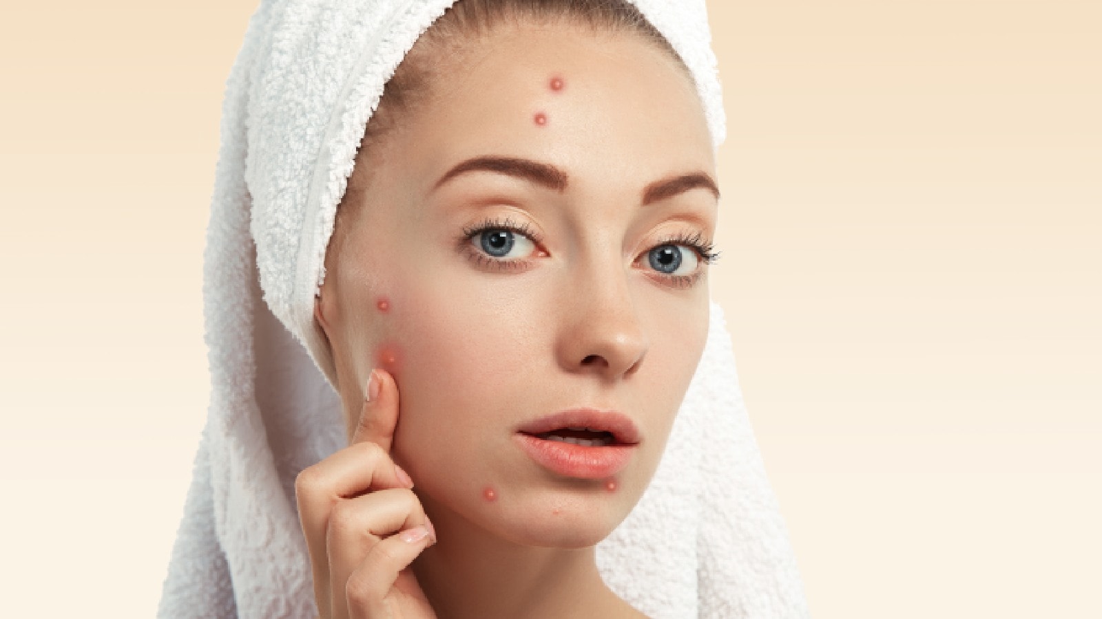 Tips to get rid of acne at home