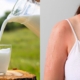 Is cold milk good for sunburn?