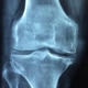 New research indicates that steroid creams can affect bone health